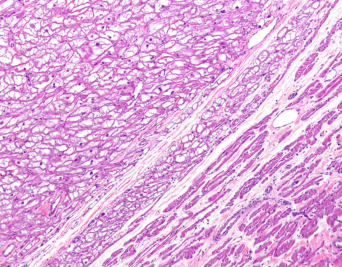 Cardiac rhabdomyoma, light micrograph