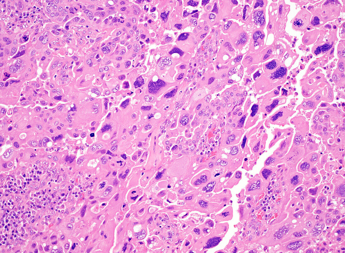 Endometrioid carcinoma of the uterus, light micrograph