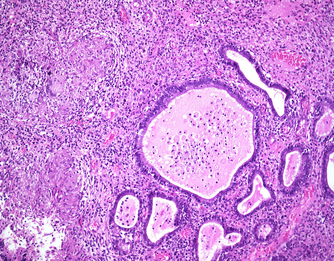 Tuberculous endometritis, light micrograph