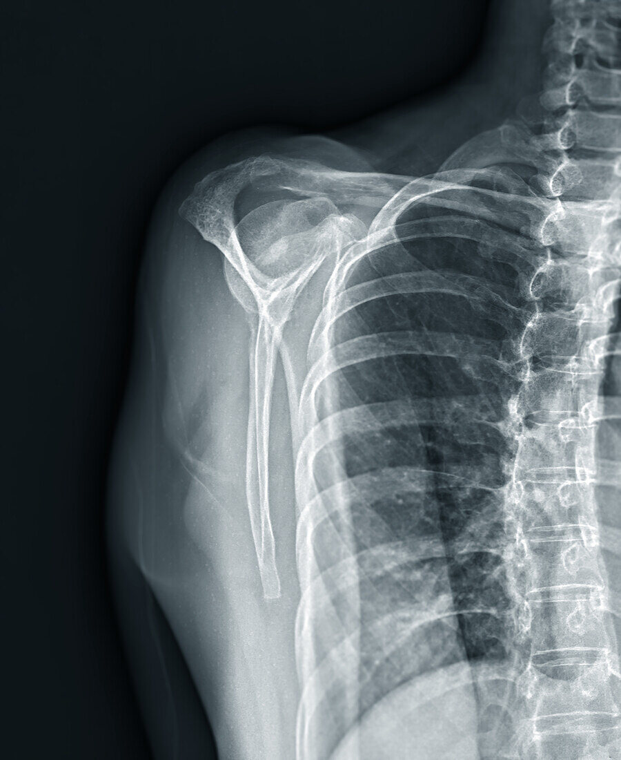 Fractured shoulder, X-ray
