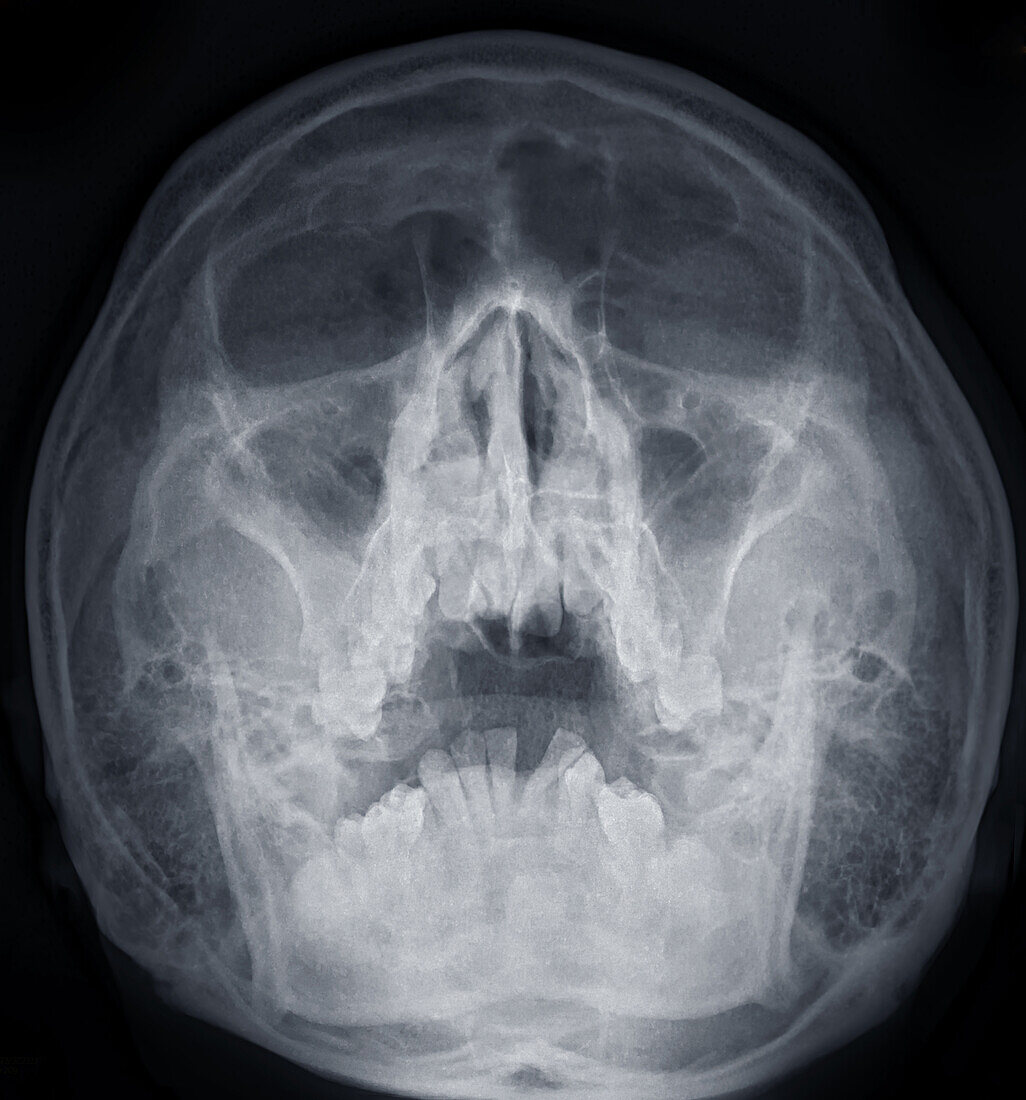 Healthy sinuses, X-ray