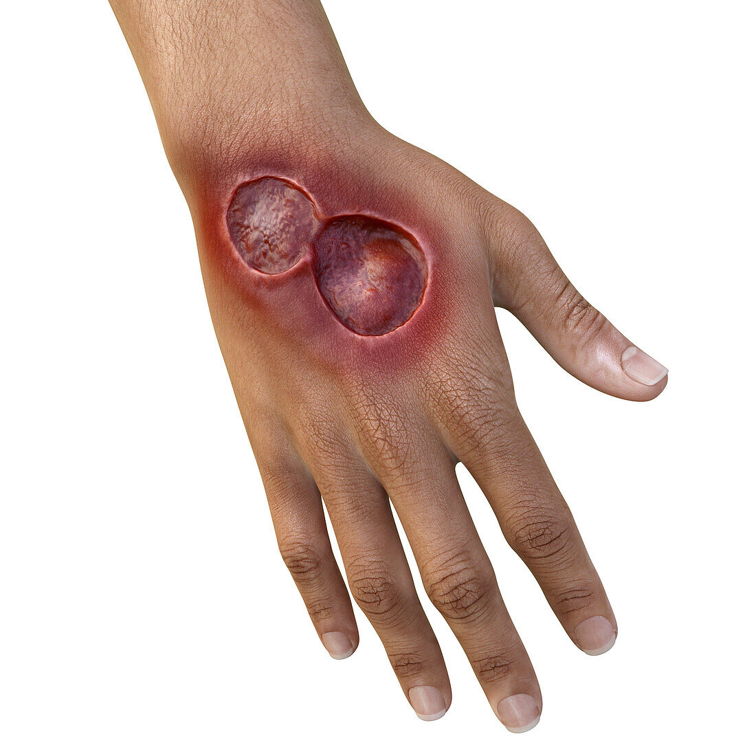 Buruli ulcer on a hand, illustration