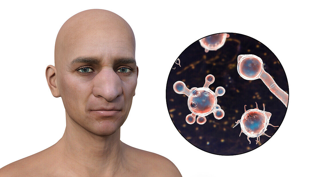 Rhinofacial conidiobolomycosis and fungus, illustration