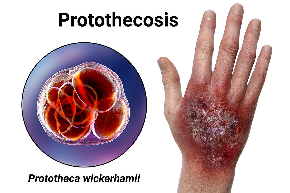Protothecosis infection on a human hand, illustration