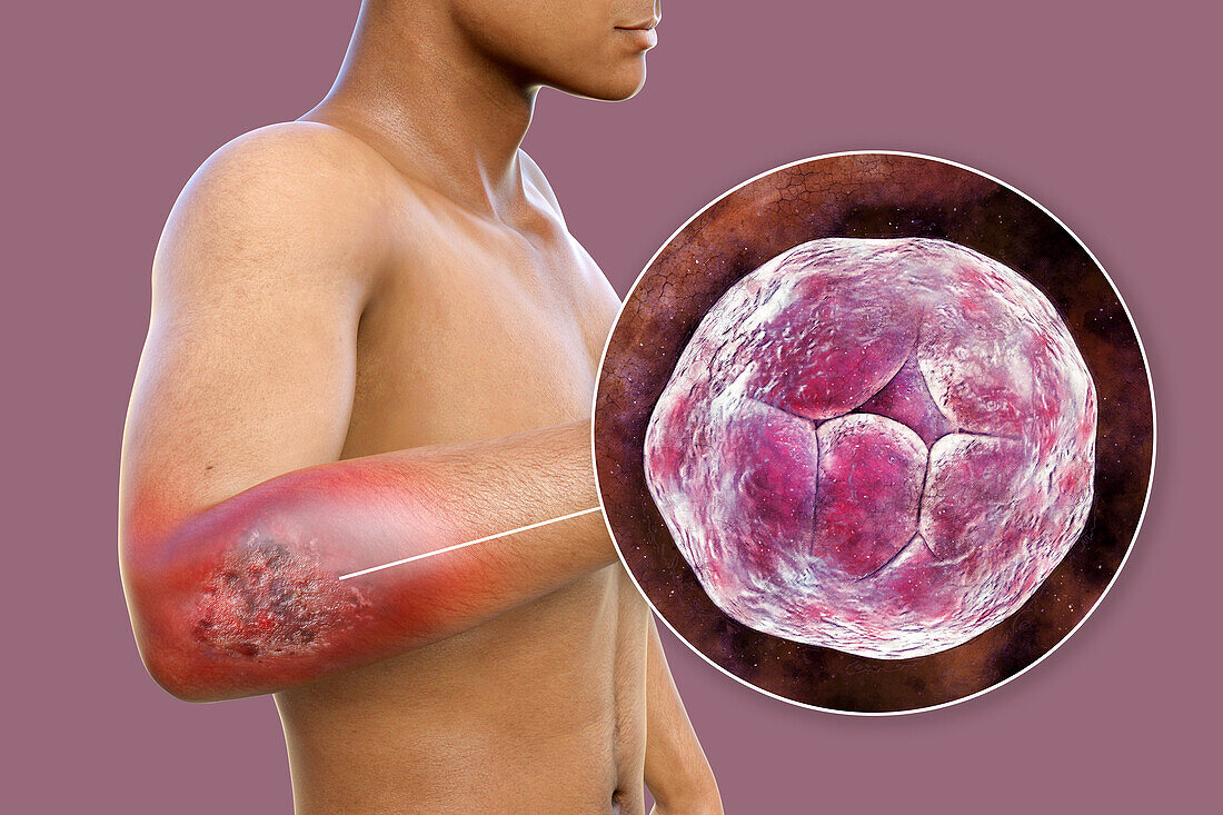 Protothecosis infection on a human elbow, illustration