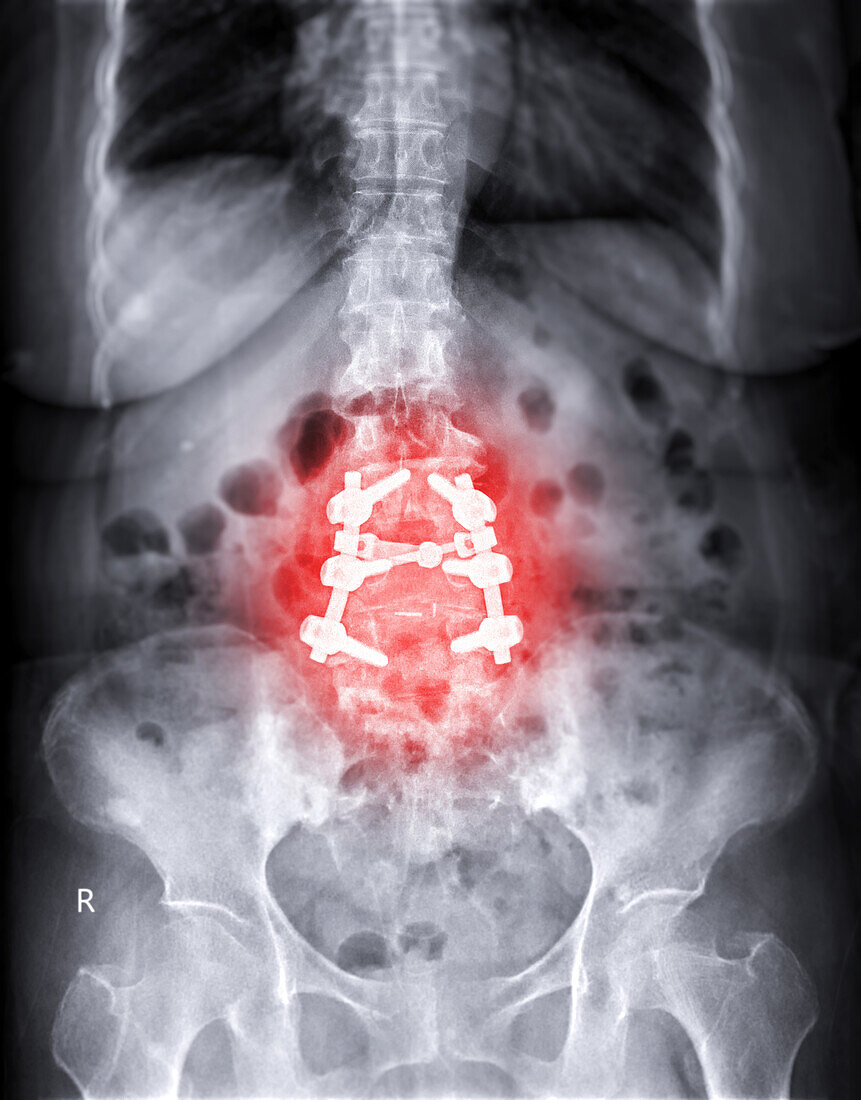 Spinal stenosis after surgery, X-ray