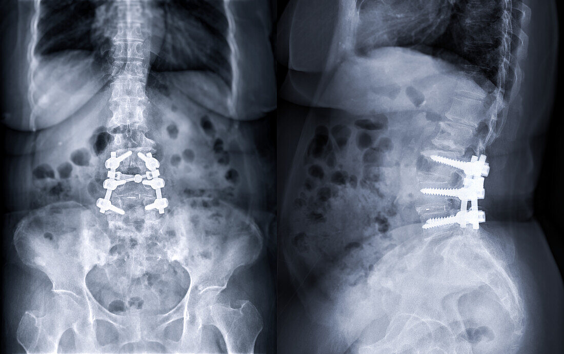 Spinal stenosis after surgery, X-rays