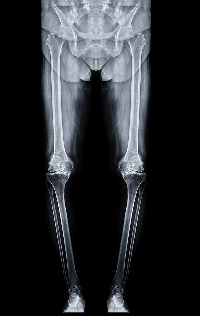 Healthy lower body, X-ray