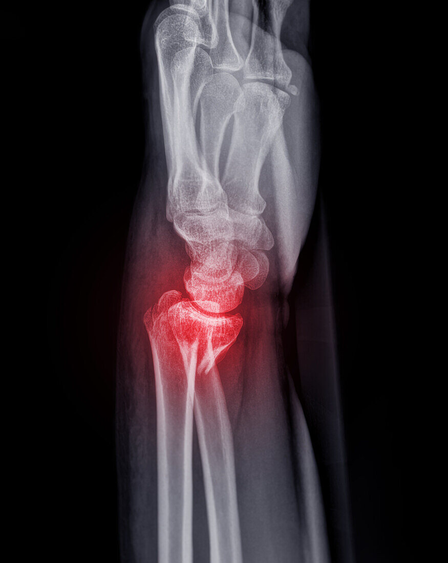 Fractured ulna, X-ray
