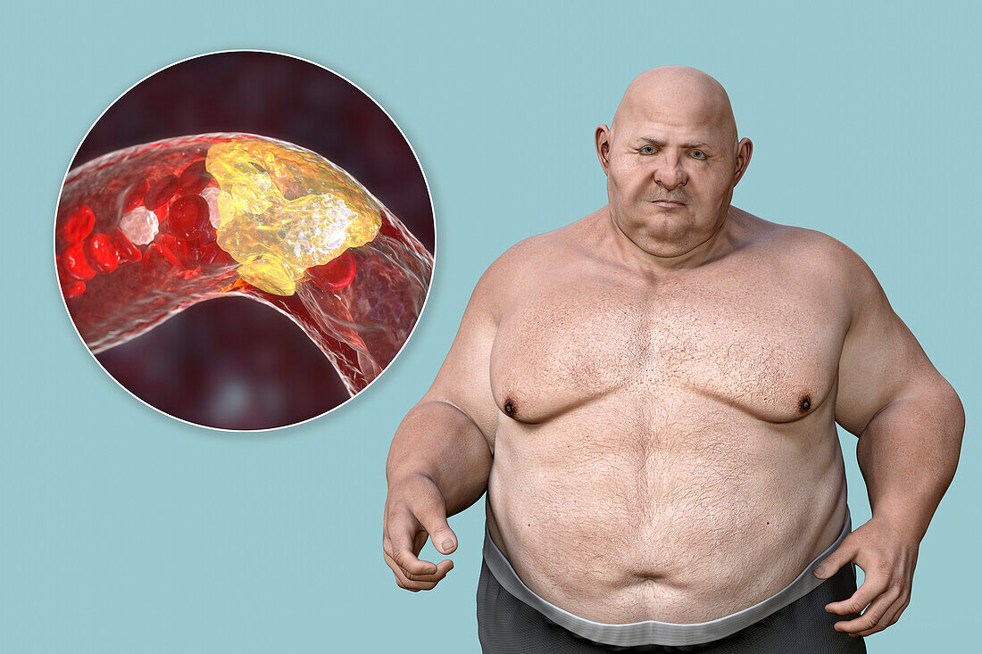 Obesity and atherosclerosis, conceptual illustration