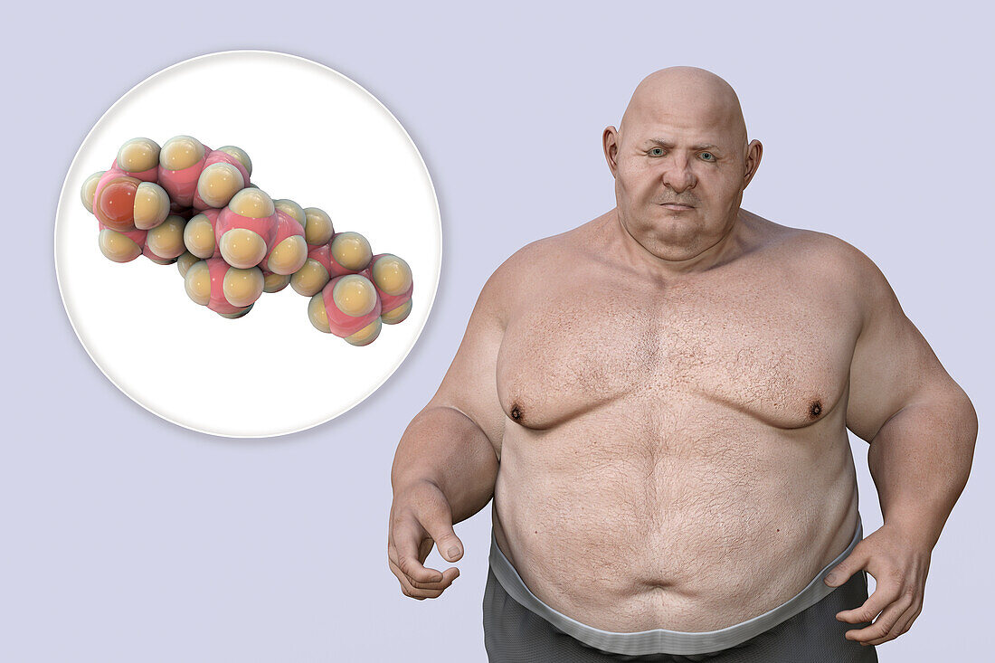 Obesity and dyslipidaemia, conceptual illustration