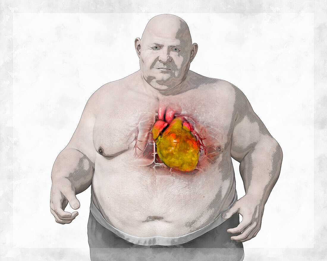 Fatty heart in overweight man, illustration.
