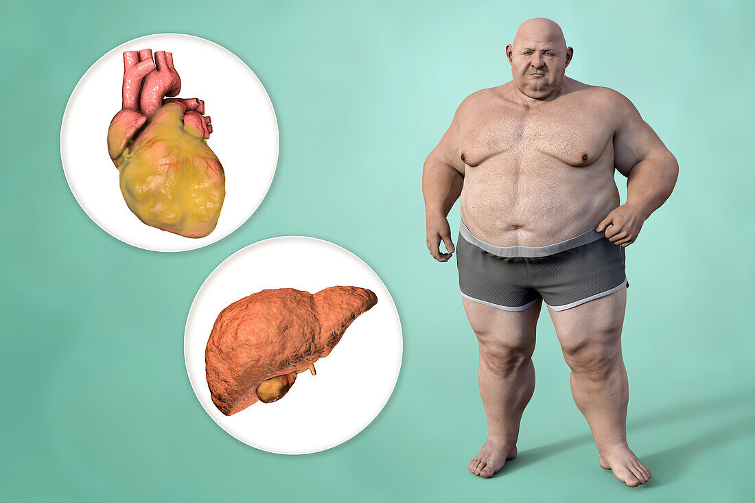 Fatty heart and liver in overweight man, illustration.