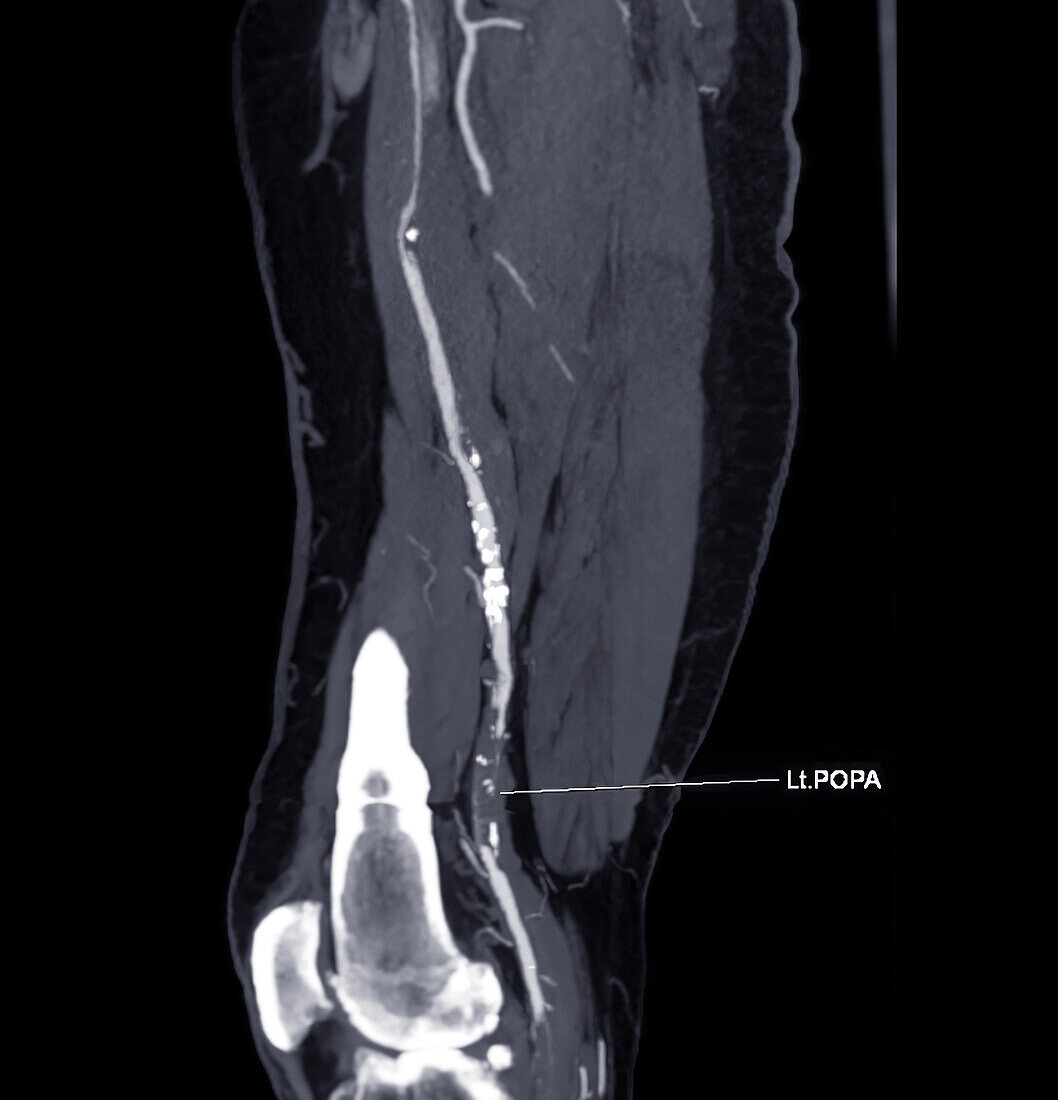 Popliteal artery, CT scan