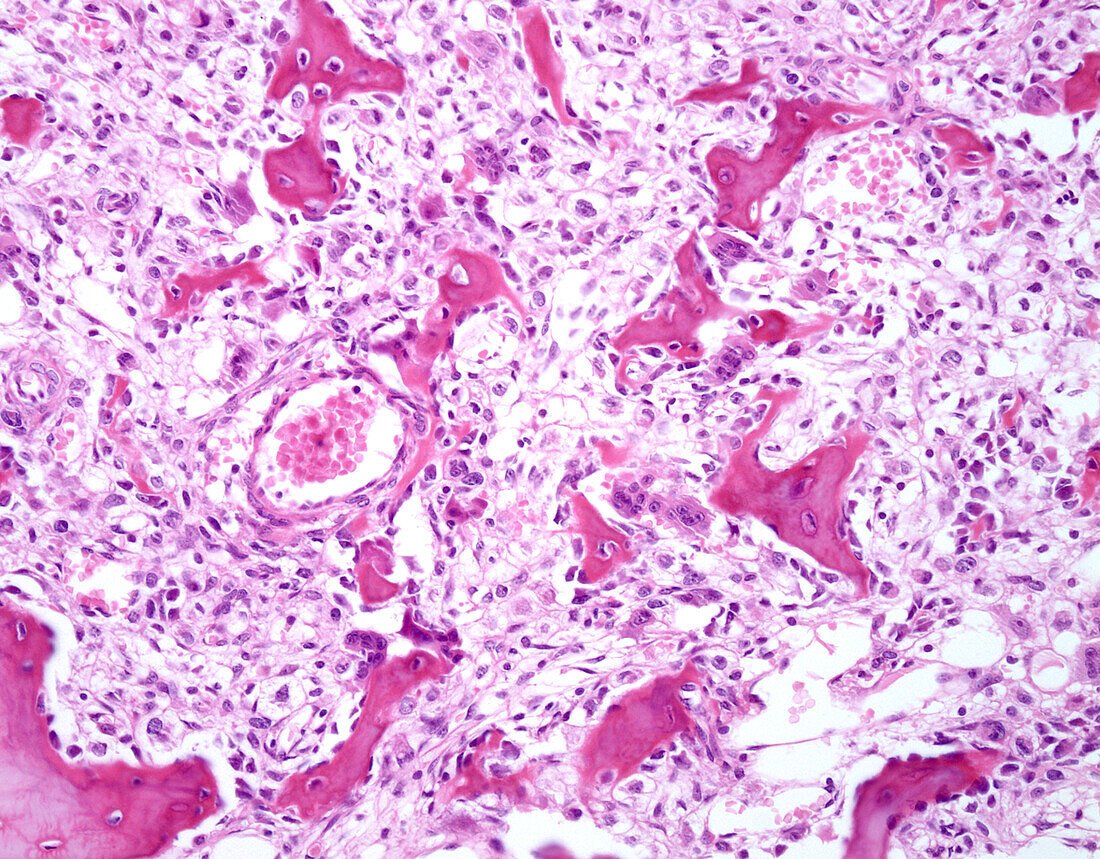 Clear cell chondrosarcoma, light micrograph