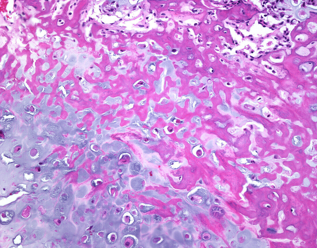 Chondroblastic osteosarcoma, light micrograph