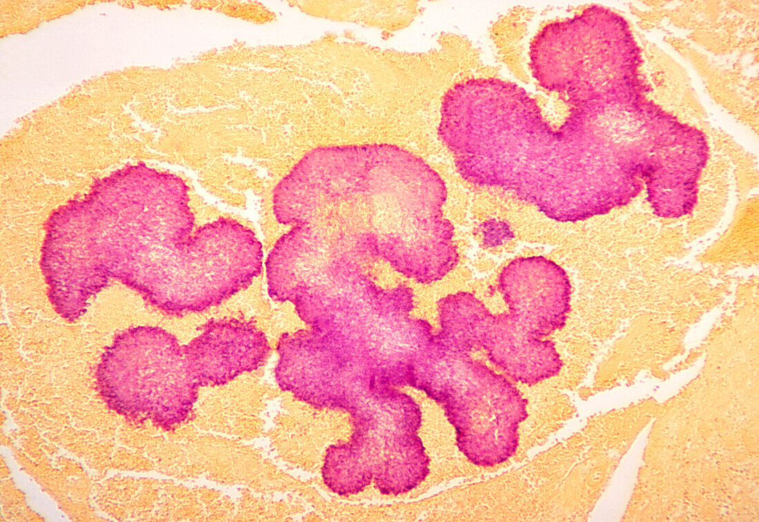 Madurella mycetomatis fungal infection, light micrograph