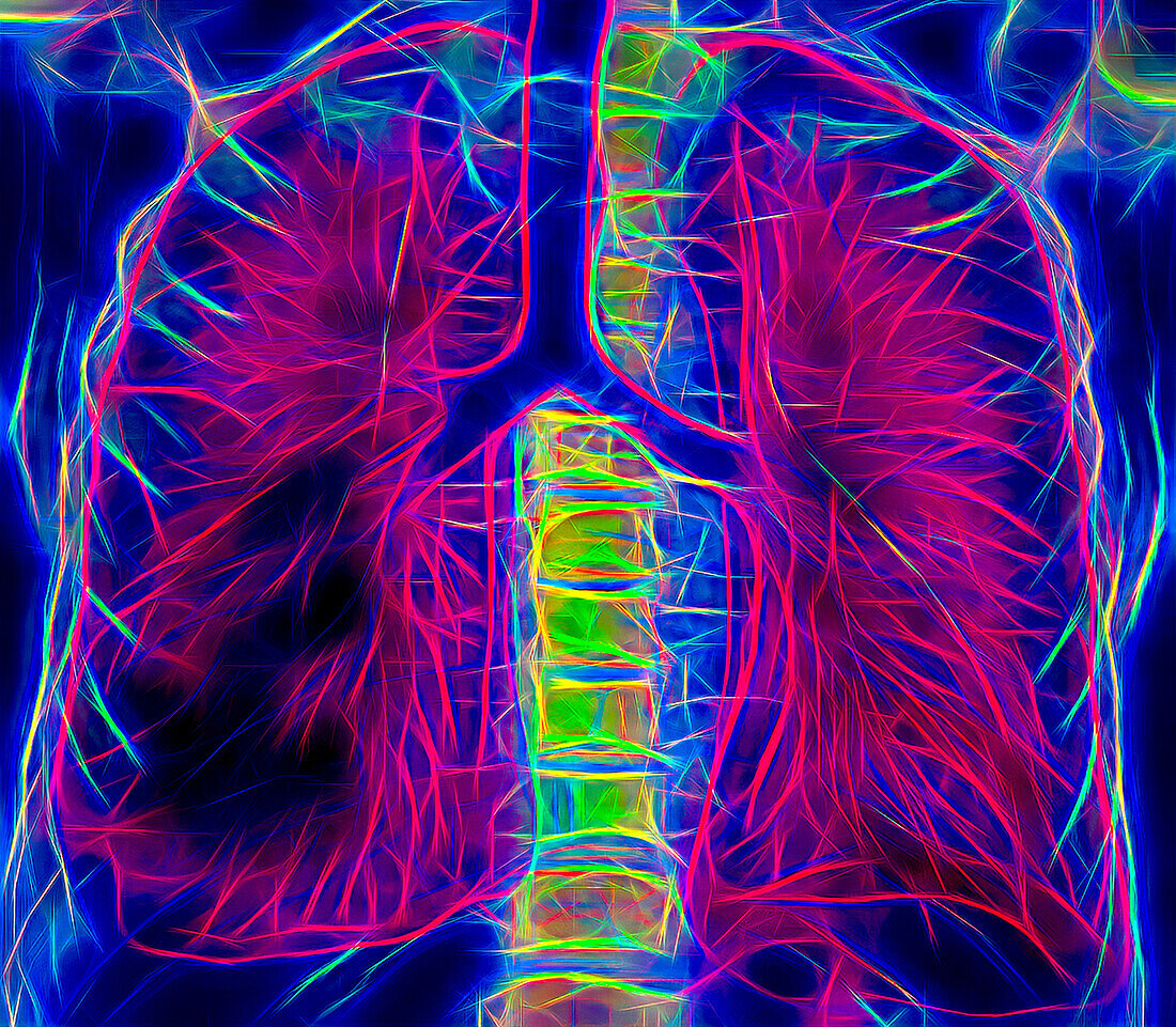 Healthy lungs, CT scan