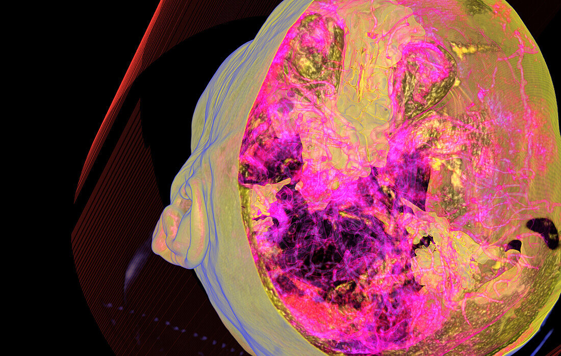 Cerebral arteries, CT scan