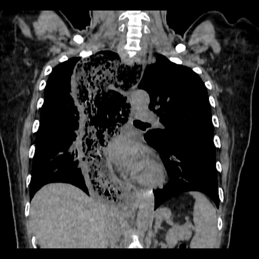Achalasia of the oesophagus, CT scan