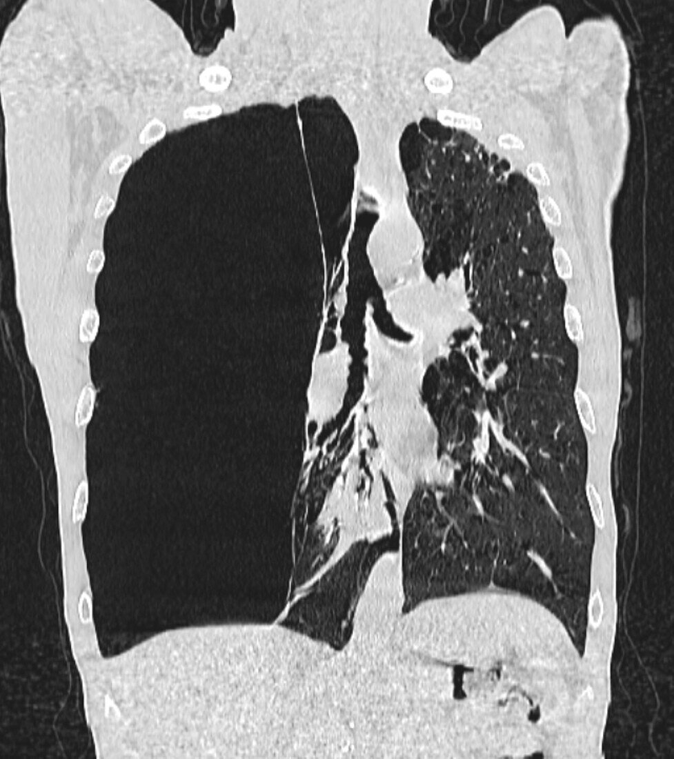 Pulmonary giant bulla, CT scan