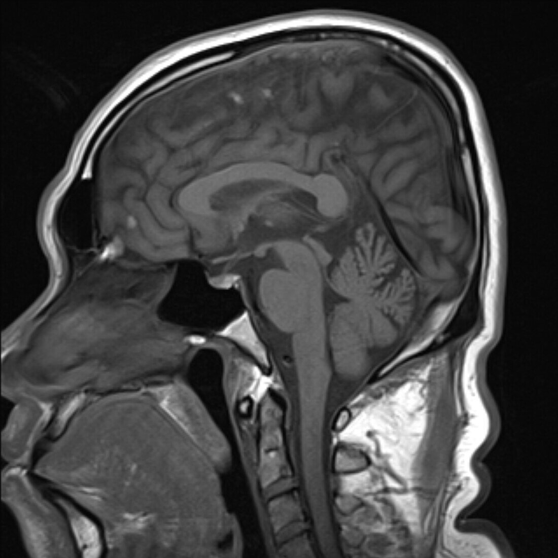Healthy human brain, MRI scan