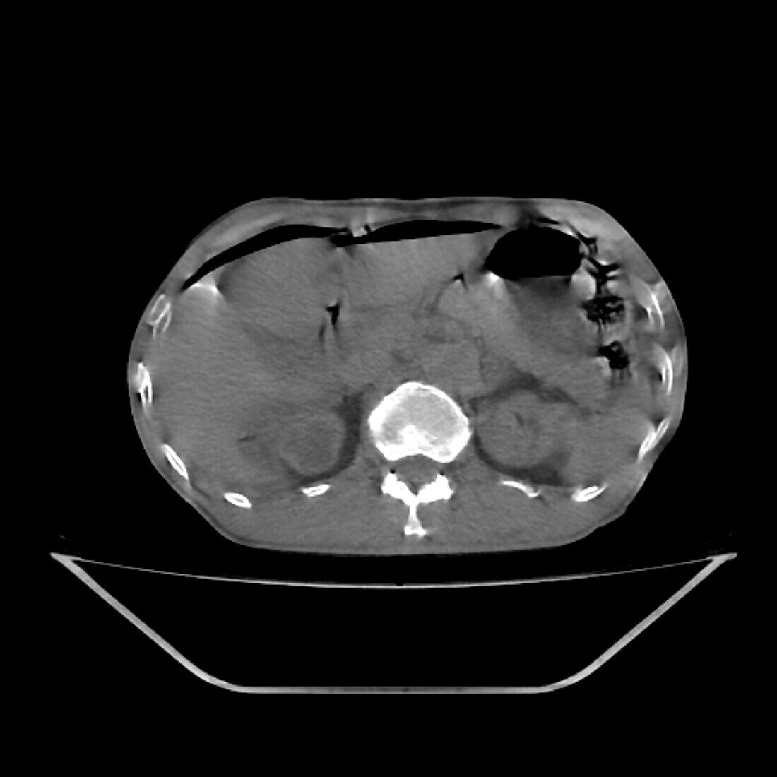 Pneumoperitoneum, CT scan