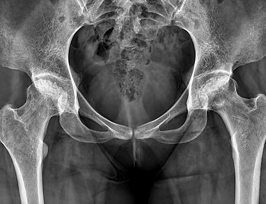 Hip disease, X-ray