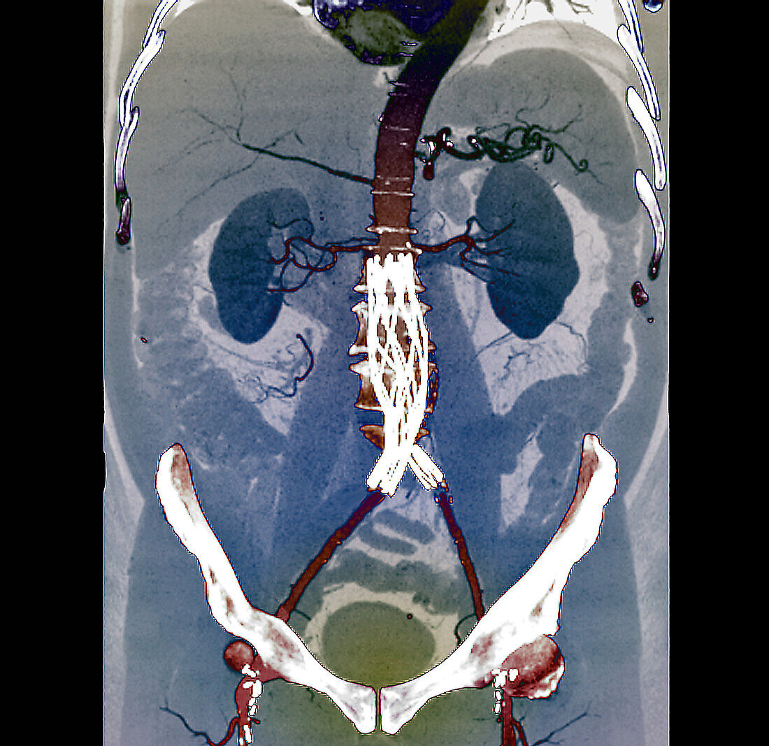 Aortic aneurysm stent, CT scan