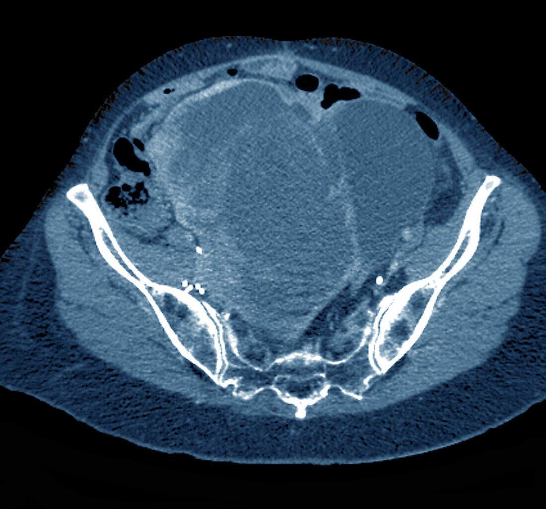 Pelvic tumour, CT scan