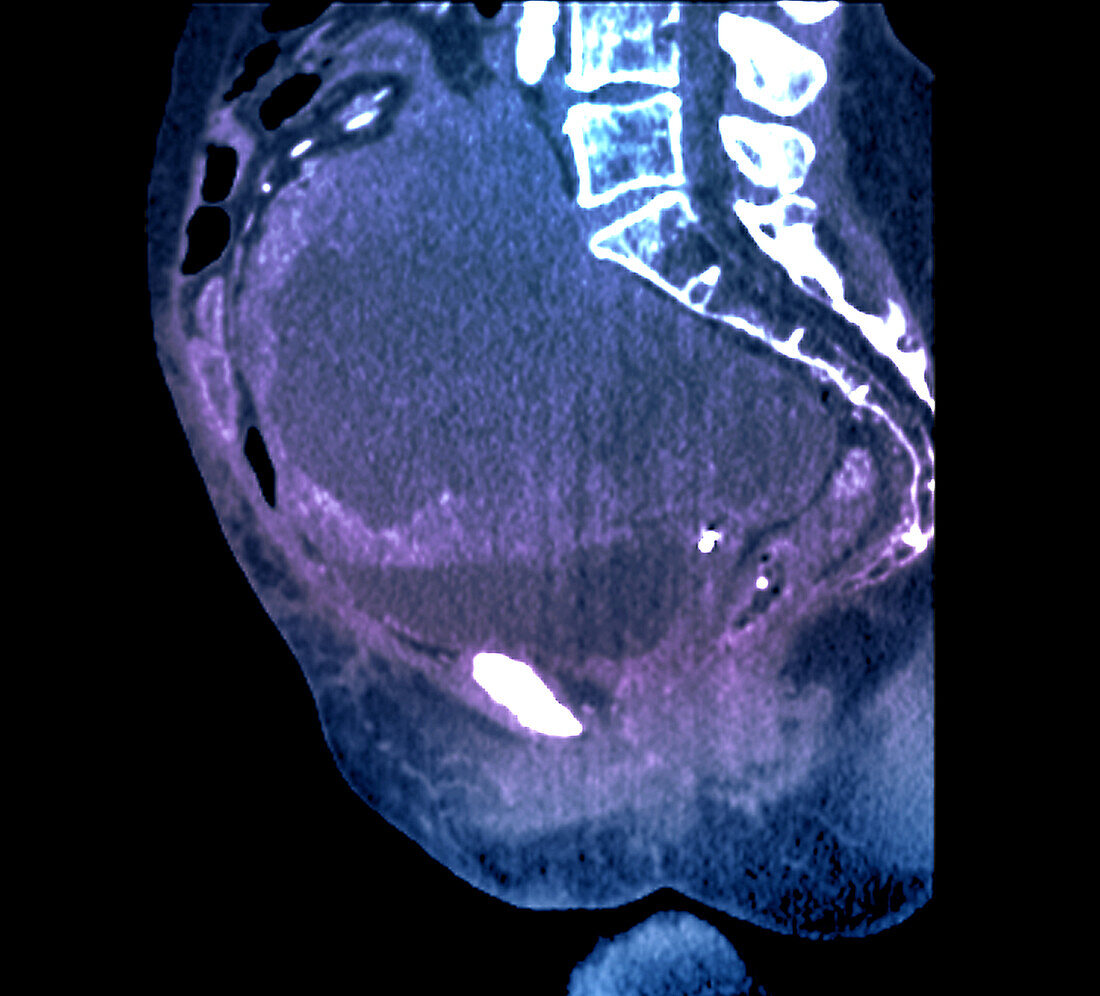 Pelvic tumour, CT scan