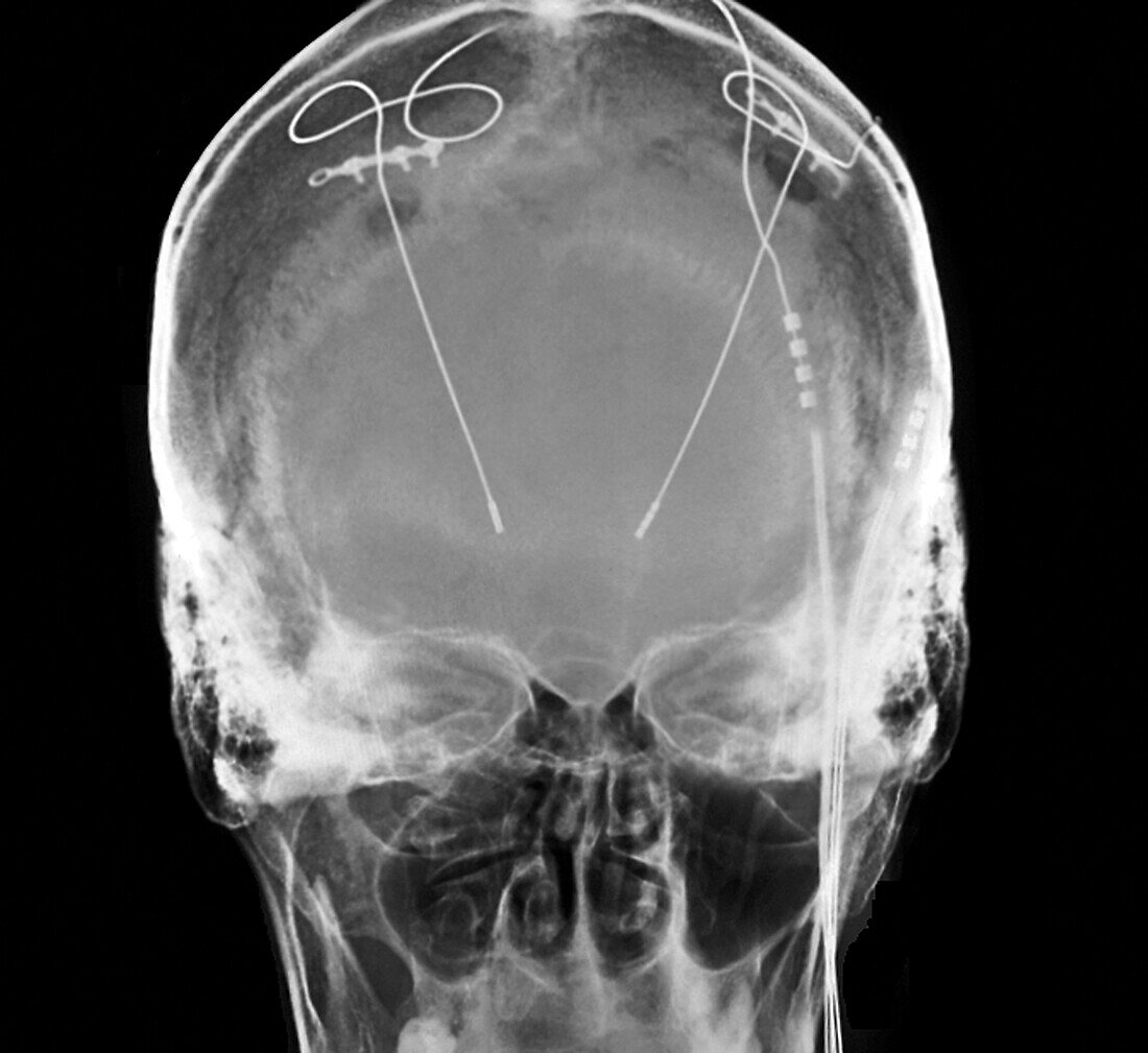 Parkinson's disease electrode implants, X-ray