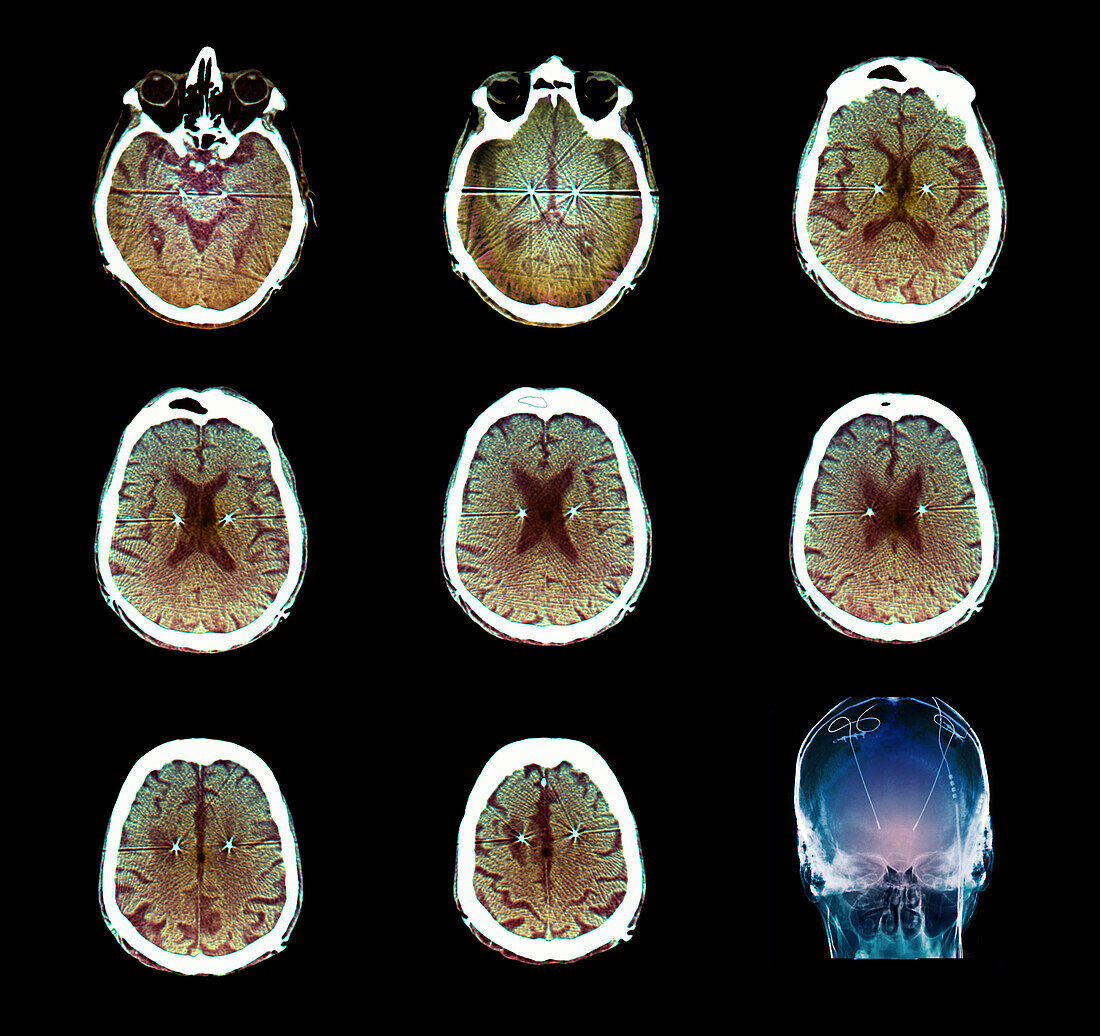 Parkinson's disease electrode implants, CT scans