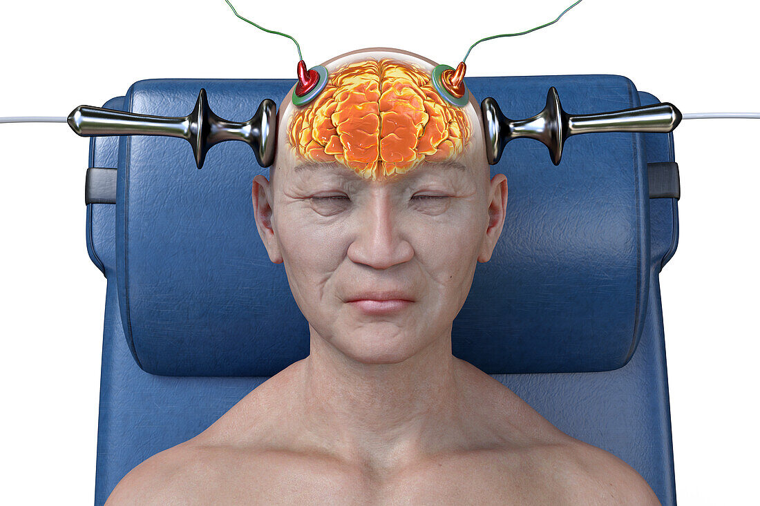 Electroconvulsive therapy, illustration
