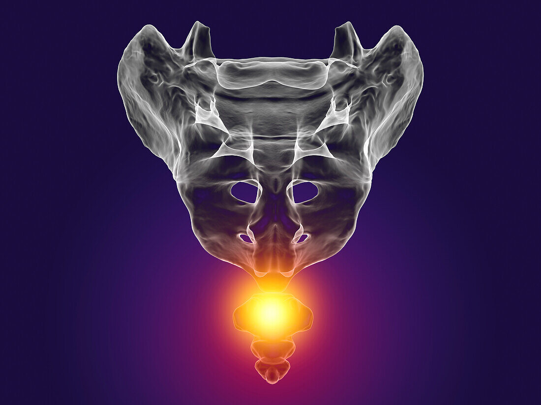 Coccyx pain, conceptual illustration