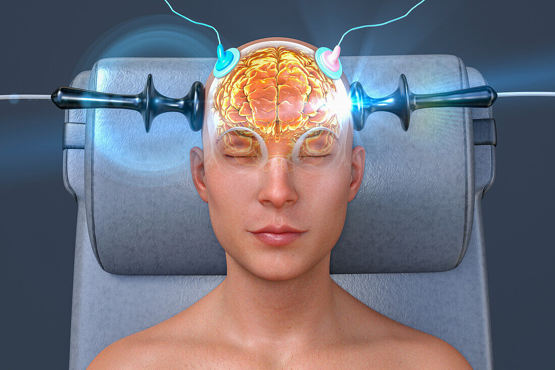 Electroconvulsive therapy, illustration