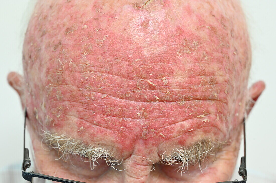 Actinic keratosis