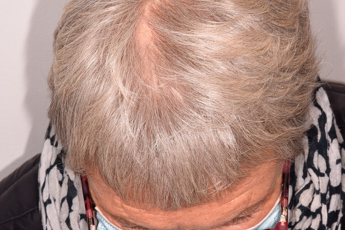 Hair regrowth in a patient with alopecia