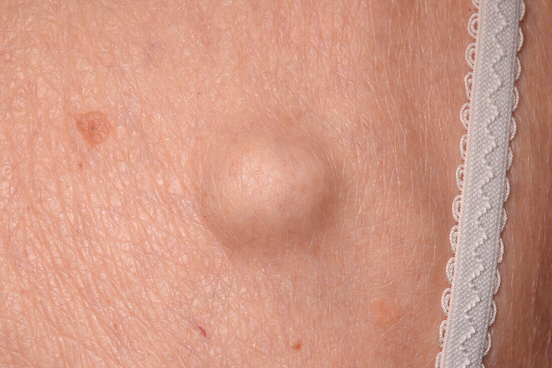 Secondary skin cancer on the back