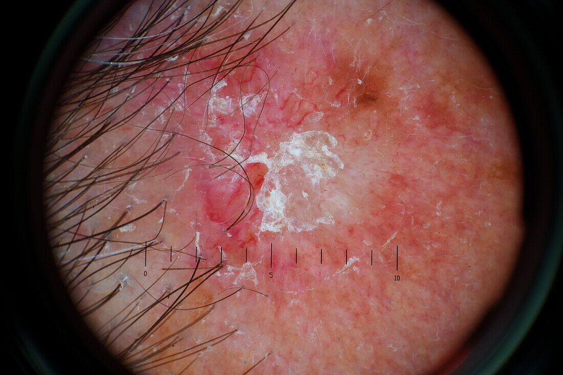 Basal cell carcinoma, dermascope image