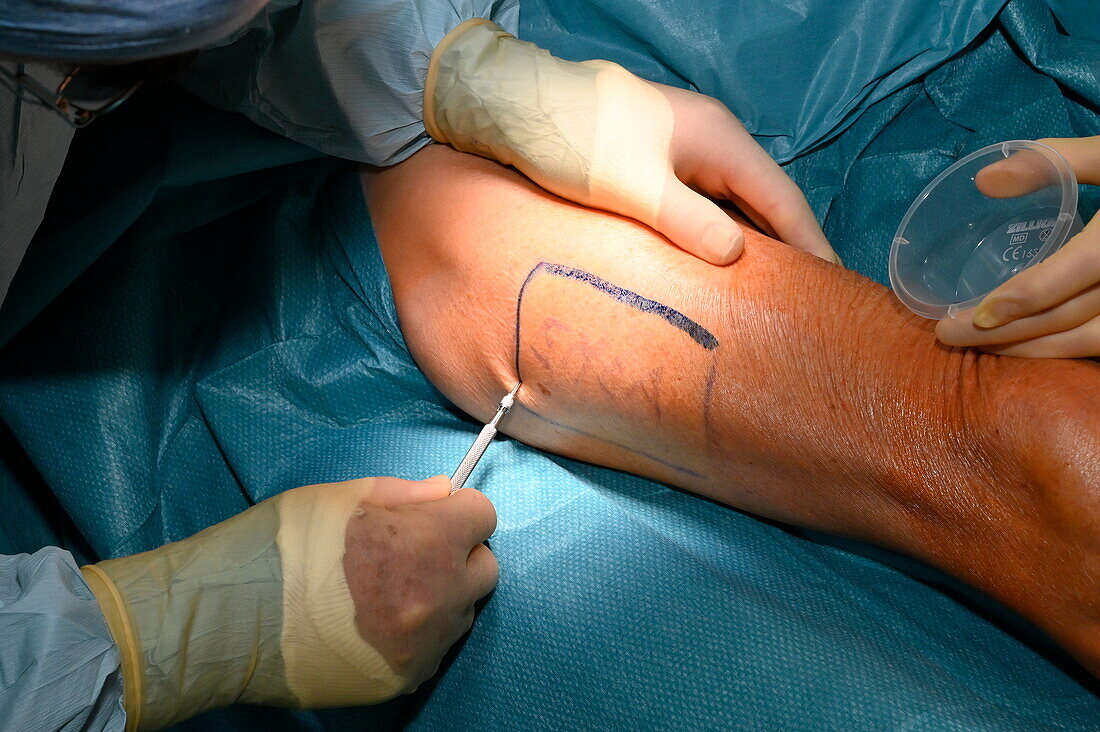 Anaesthetic being injected into the skin graft donor site