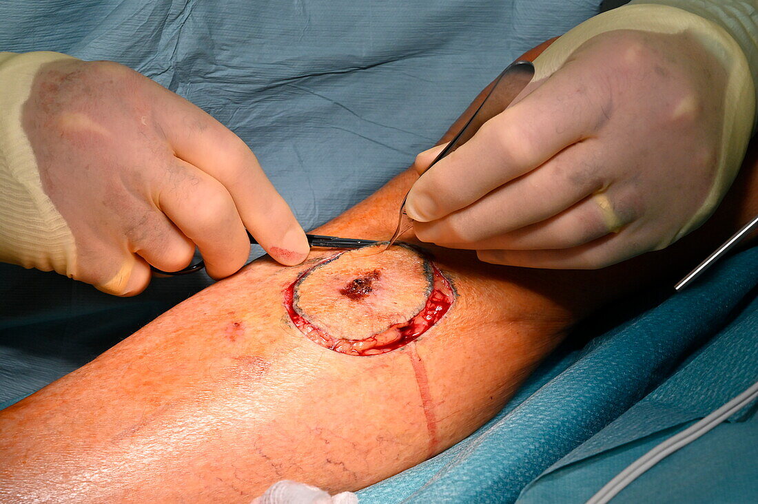 Surgeon excising squamous cell carcinoma