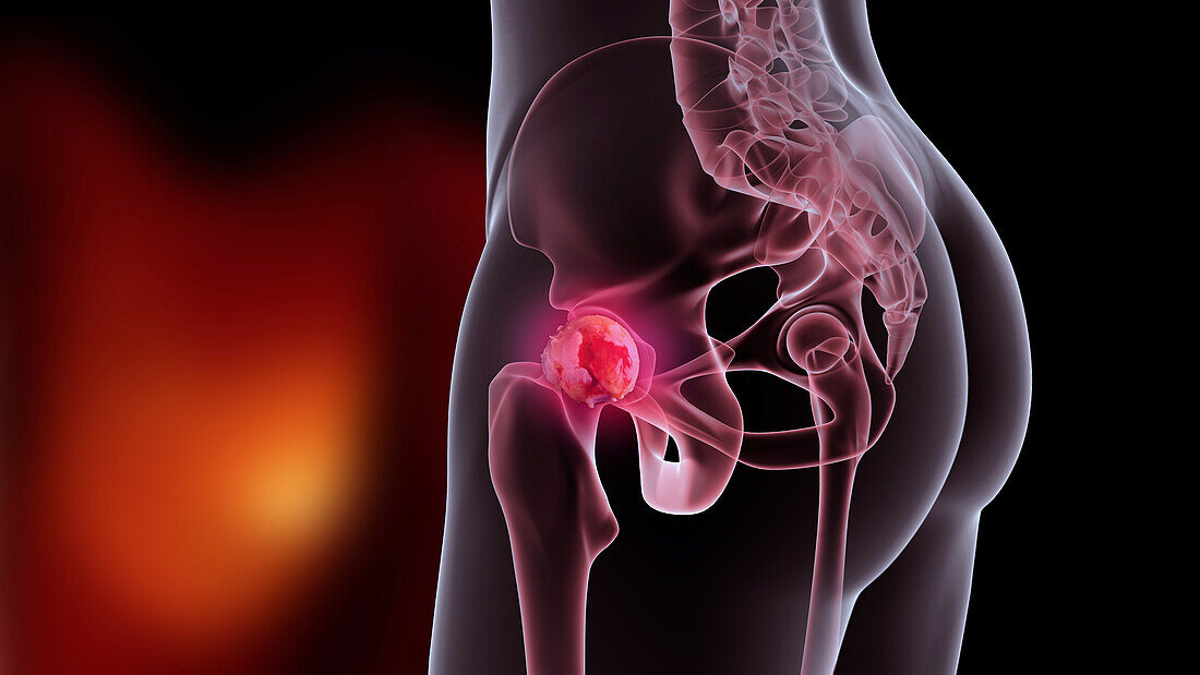 Osteoarthritis of the hip, illustration