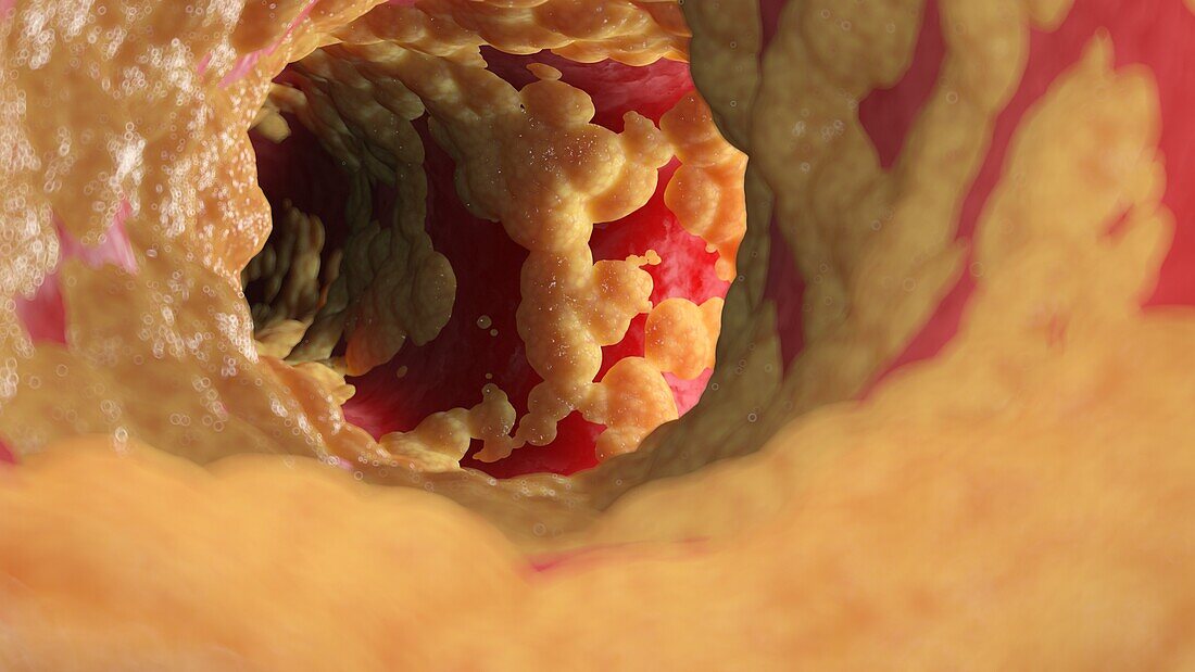 Fatty human artery, illustration