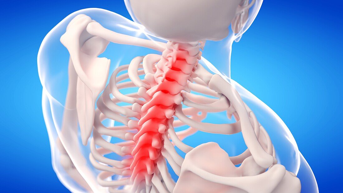 Painful cervical spine, illustration