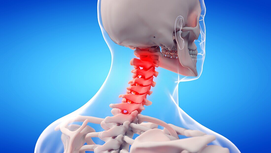 Painful cervical spine, illustration