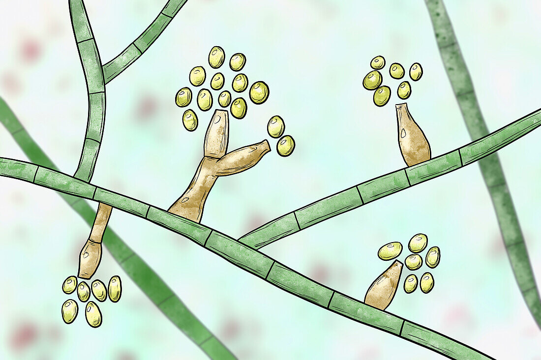 Madurella fungi, illustration