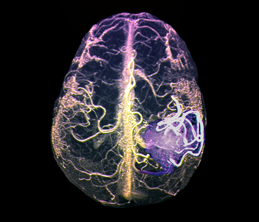 Arteriovenous malformation, MRI scan
