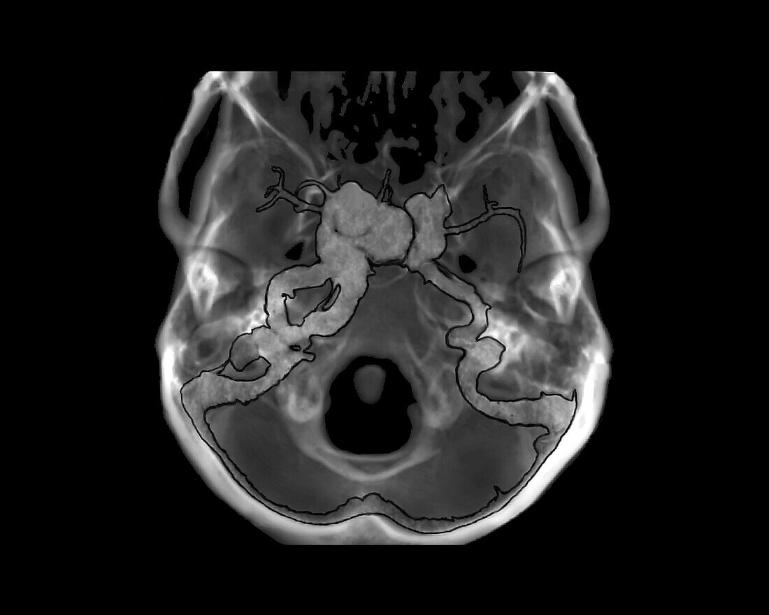 Pulsatile exophthalmos, CT angiogram