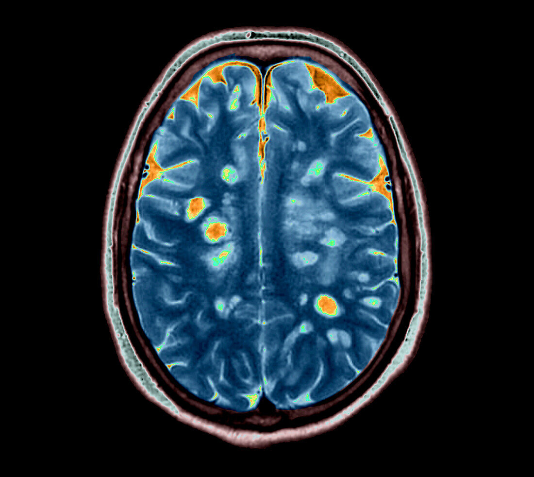 Multiple sclerosis, MRI scan